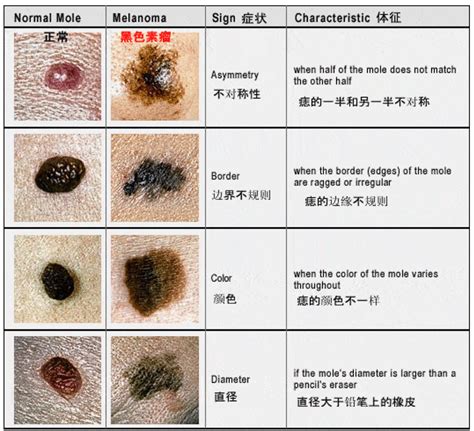 痣 斑|痣也可能会癌变！长在 3 个地方要注意